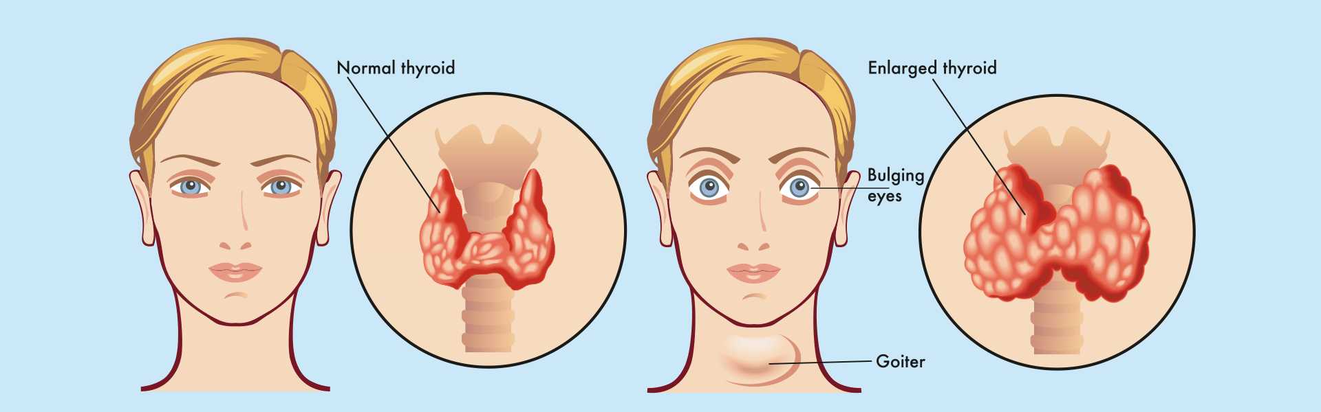 Thyroid Scan